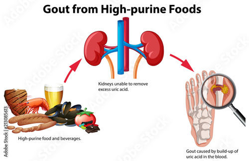 Gout from High-purine Foods