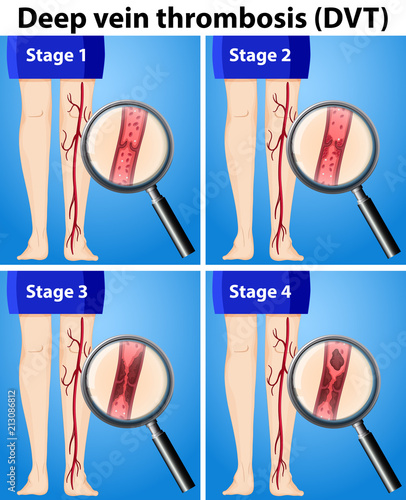 Four Stages of Deep Vein Thrombosis