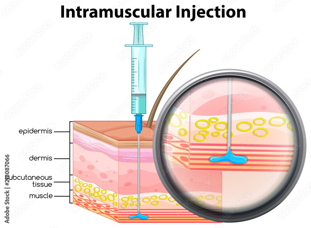 Human Skin Intramuscular Injection Stock Vector | Adobe Stock
