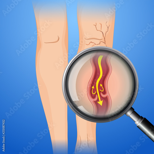 Deep Vein Thrombosis on Leg