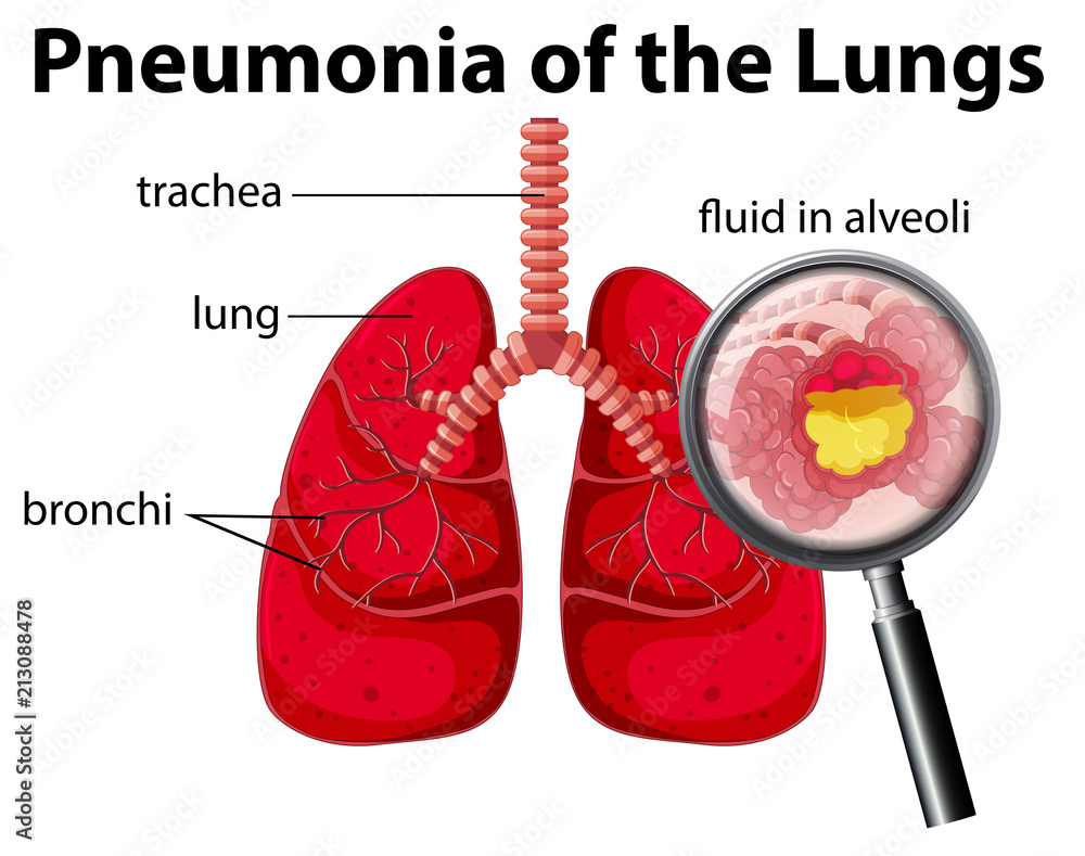 Pneumonia Of The Lungs Diagram Stock Vector Adobe Stock