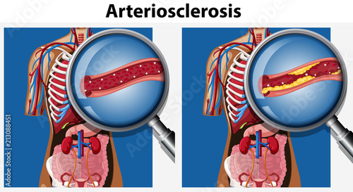 Human Anatomy with Arteriosclerosis photo