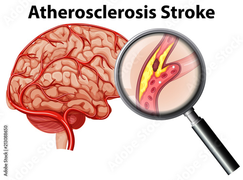 Atherosclerosis Stroke on White Background