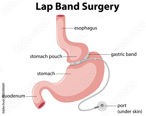 Lap Band Surgery Diagram