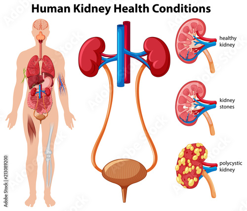 Human Kidney Health Conditions