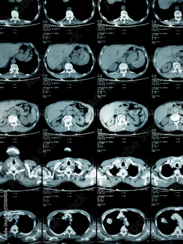 film x-ray of chest , lung cancer from patient who love smoking cigarette , health concept
