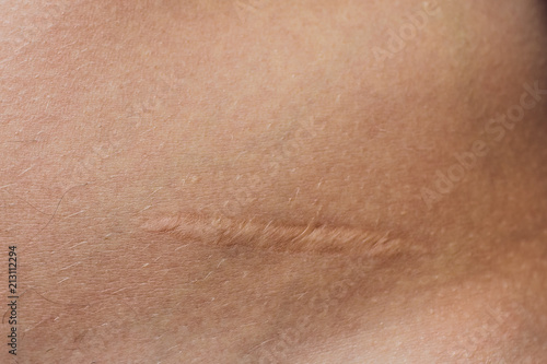 Obraz na plátně scar after surgery. Before after removal.