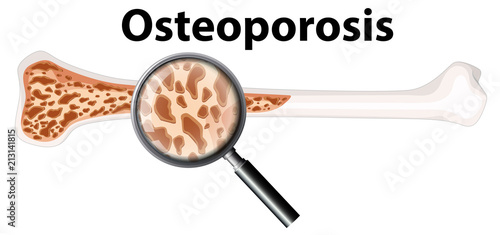 Osteoporosis and Magnifying Glass