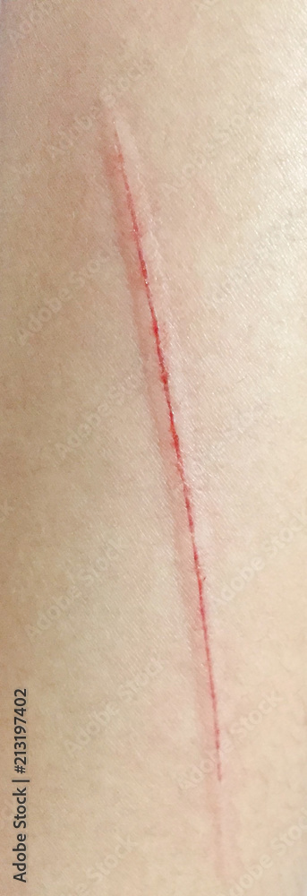 Fototapeta premium red scar on skin