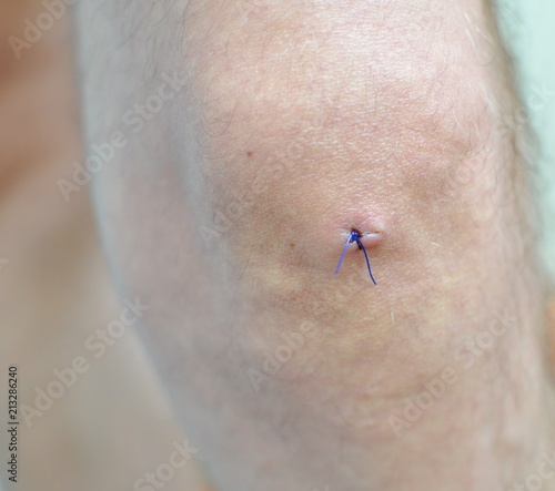 Stitches on a surgery for extirpation of a cyst to the knee, close up, surgical suture