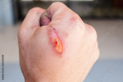 burning pain wound from burn on man's hand,