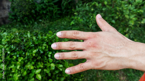 Men were bitten by an insect.