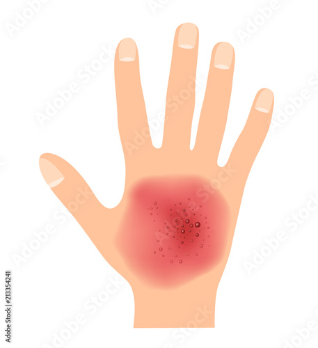 rash on hand skin vector
