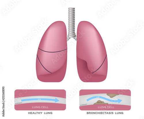 Tela Bronchiectasis in lung vector infographic