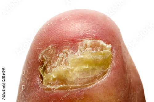 finger nail  with fungal infections onychomycosis , white background photo