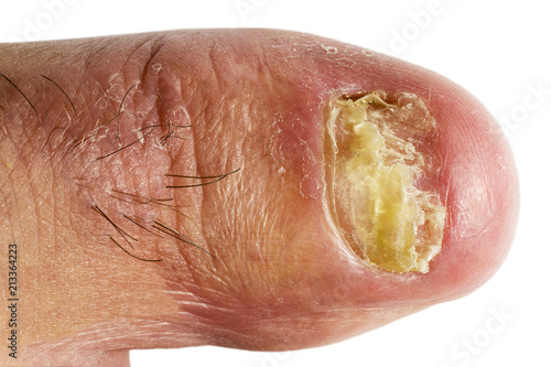 Slika na platnu finger nail  with fungal infections onychomycosis , white background