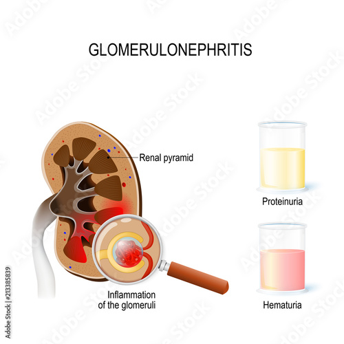 Glomerulonephritis (glomerular nephritis). Human kidney, and close-up glomeruli with inflammation and two glasses  with urine photo