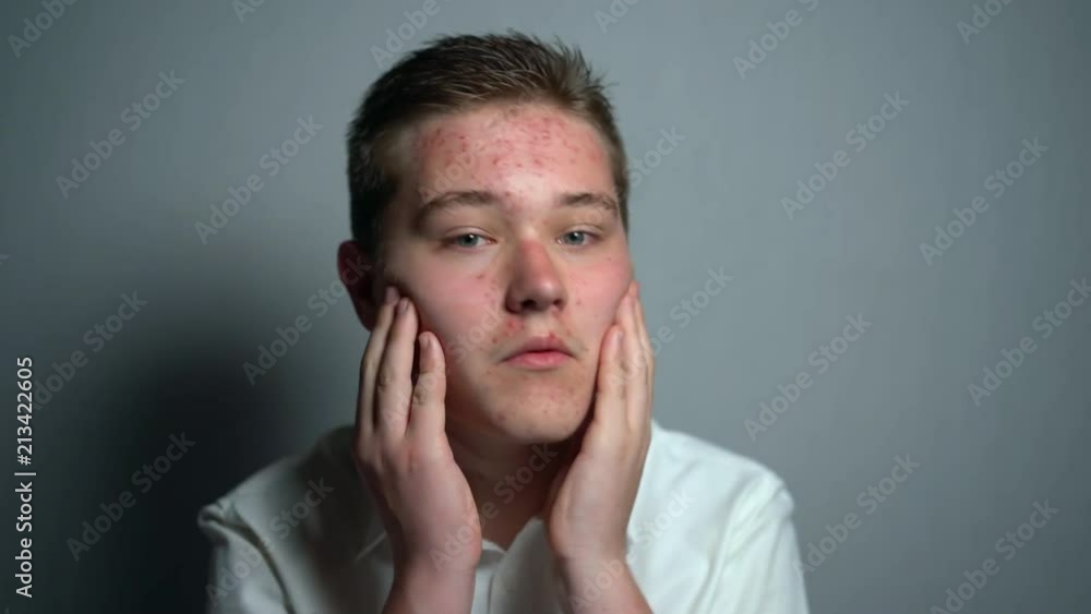 Embarrassed teenager boy looking at the camera and touching his face with acne Embarrassed teenager boy looking at the camera and touching his face with acne