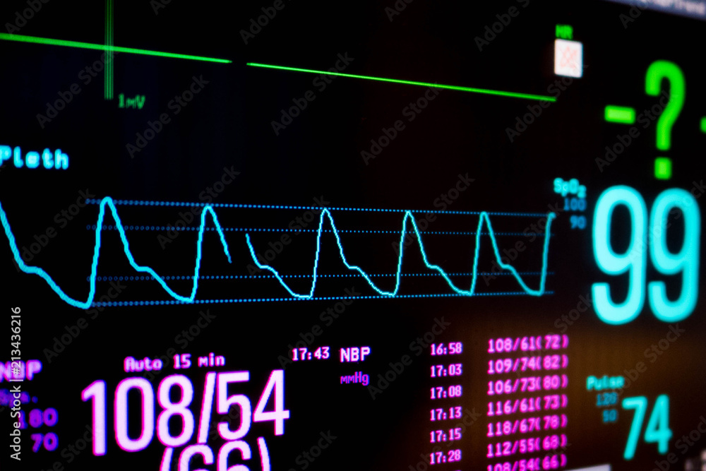 Normal heart function on pulse oximeter pleth graph bar Stock Photo | Adobe  Stock