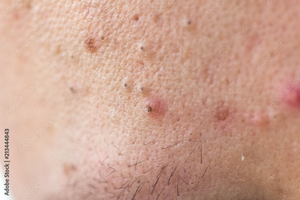 Black dots on face and pimples macro, comedo