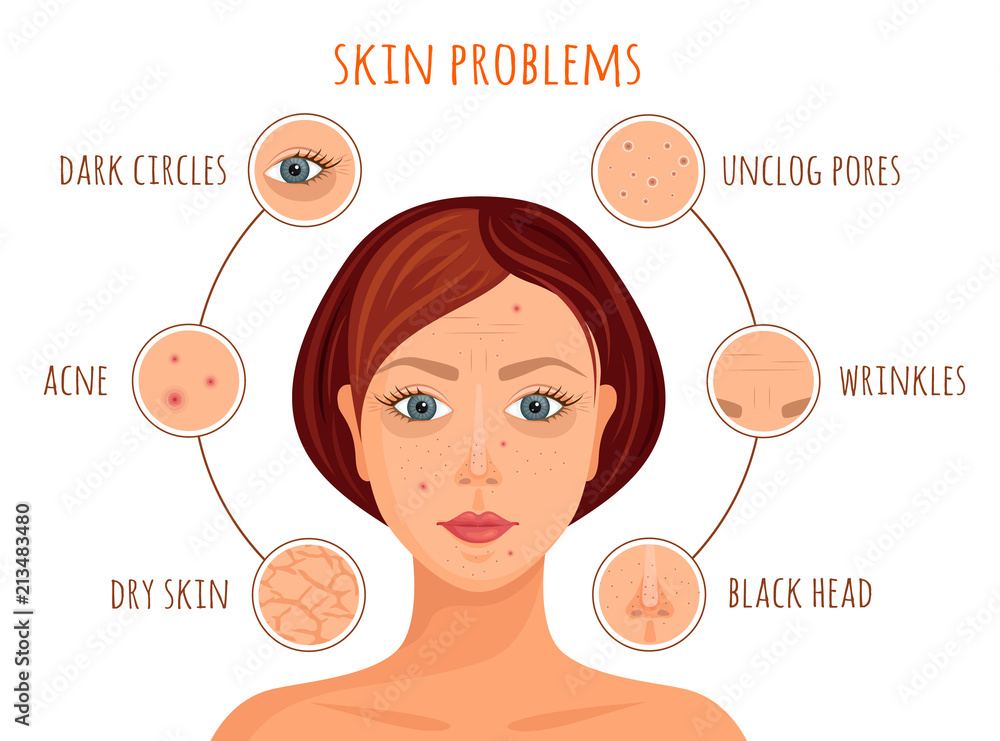 Types Of Skin Problems Vector Illustration Information Banner On The