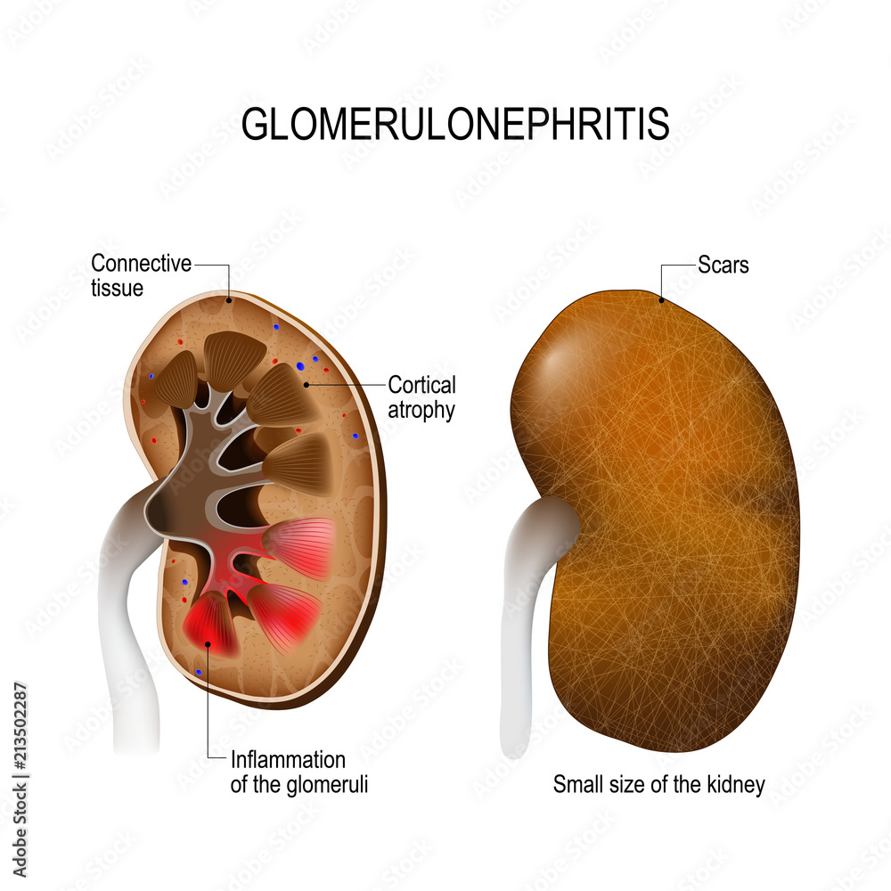 Fototapeta premium Glomerulonephritis.