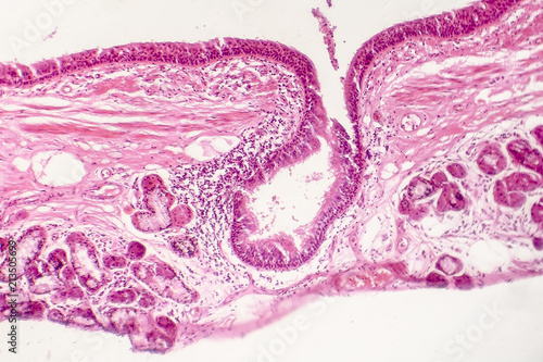 Squamous metaplasia of bronchial epithelium, light micrograph, photo under microscope
