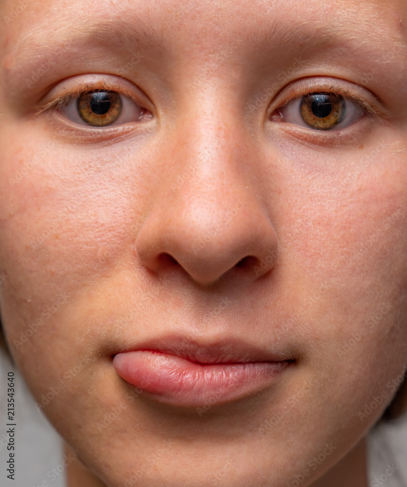 junges Mädchen Gesicht mit dicker Lippe / Lippenherpes junges Mädchen Gesicht mit dicker Lippe / Lippenherpes