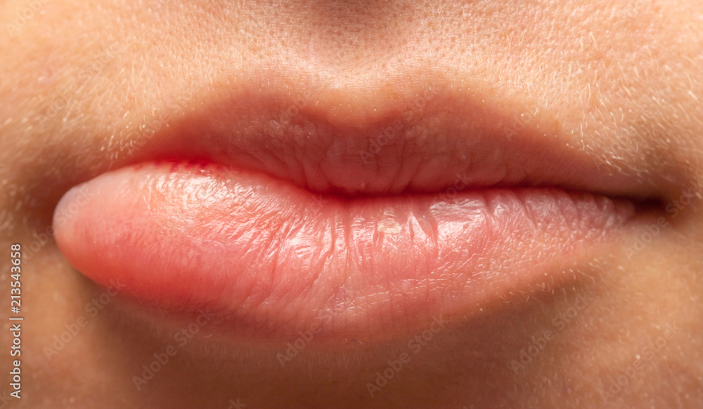 Orale Lippen Herpes Infektion, / Lippe aufgebissen, Orale Lippen Herpes Infektion, / Lippe aufgebissen,