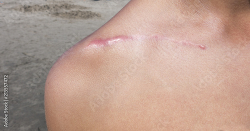 Fototapeta surgical scar over the scapula shoulder