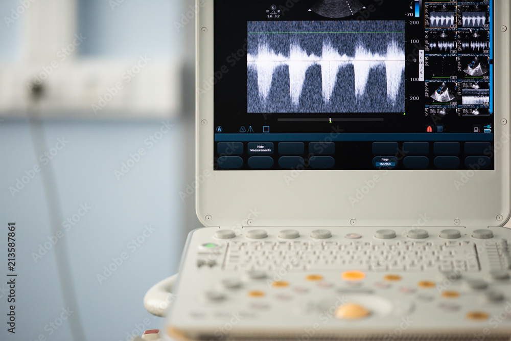 Photo of the ultrasound scanner screen showing the measurement of the pressure gradient between the right ventricle and the pulmonary artery.