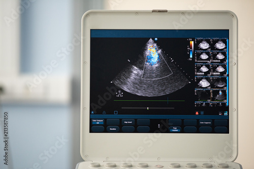Photo of the screen of an ultrasound scanner with the image of a heart scan, where valvular regurgitation is assessed using the Doppler method.