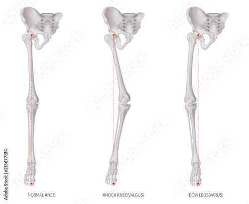 Alignment types disease of lower half limbs or leg bone problem- Normal- Knock knee and Bowlegs or Valgus and Varus knee- 3D medical illustration-human anatomy and educational concept white background