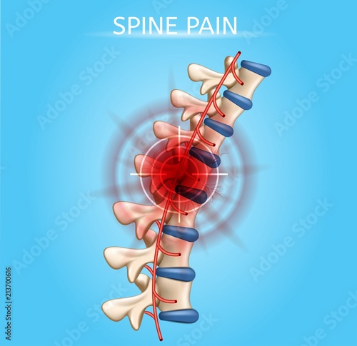 Human Spine Pain Realistic Vector Medical Scheme