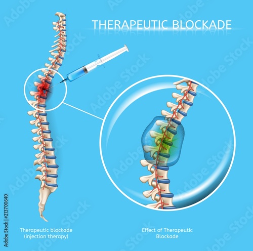 Therapeutic Blockage of Spine Diseases Vector