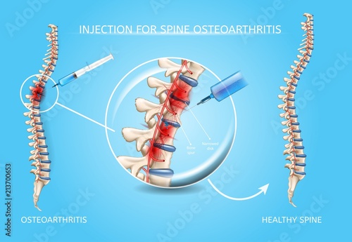Spine Osteoarthritis Medical Treatment Vector