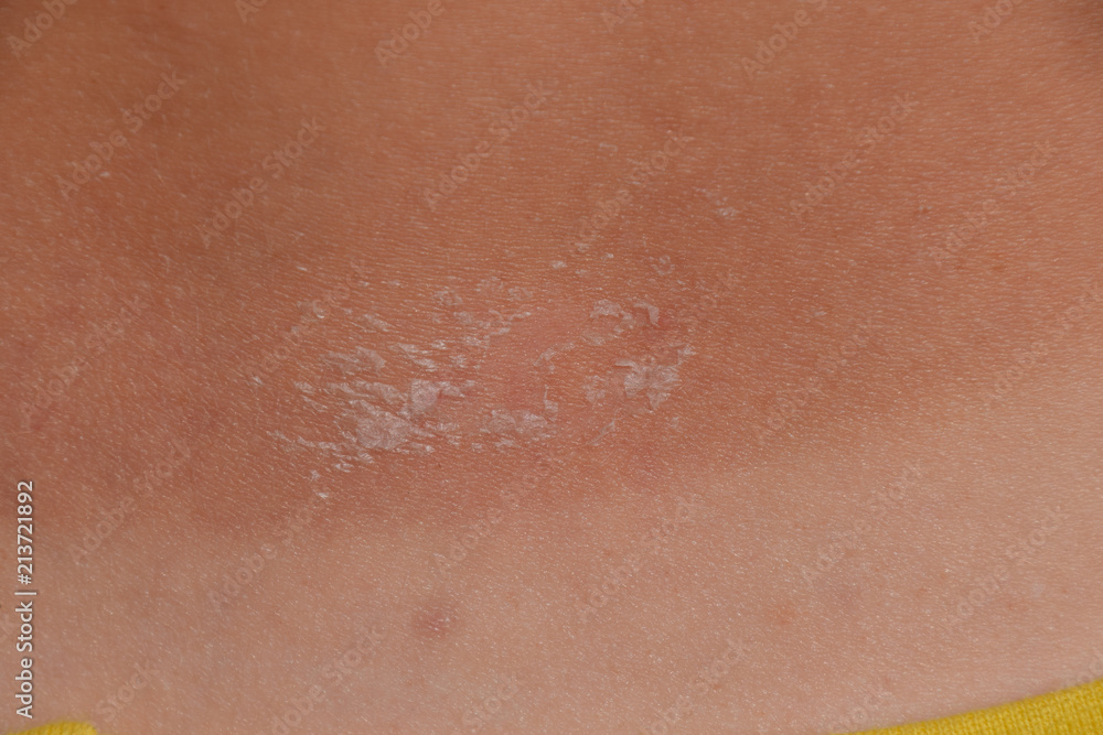 Fototapeta premium Sunburn on the skin of the back. Exfoliation, skin peels off. Dangerous sun tan