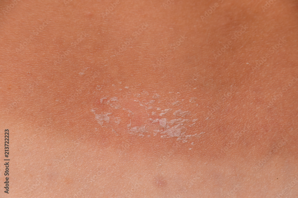 Fototapeta premium Sunburn on the skin of the back. Exfoliation, skin peels off. Dangerous sun tan