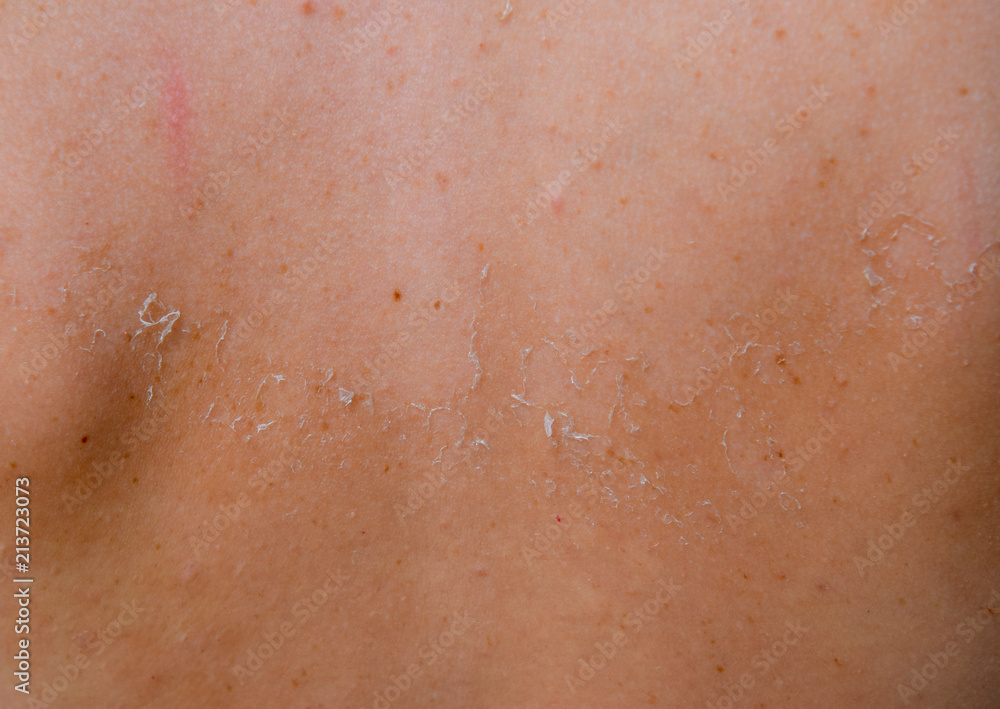 Sunburn on the skin of the back. Exfoliation, skin peels off. Dangerous sun tan Sunburn on the skin of the back. Exfoliation, skin peels off. Dangerous sun tan