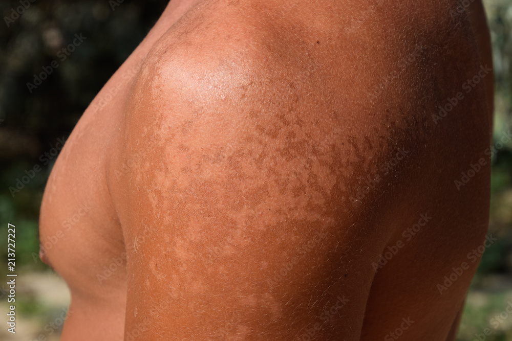 Sunburn on the skin of the shoulders. Exfoliation, skin peels off. Dangerous sun tan Sunburn on the skin of the shoulders. Exfoliation, skin peels off. Dangerous sun tan