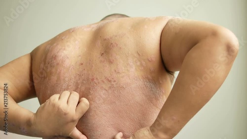Men is their hands to scratch the wound. Diseases caused by abnormalities of the lymph. Psoriasis is a skin disease.