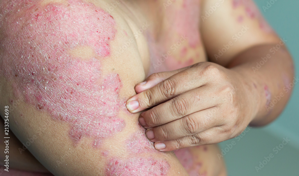 Diseases caused by abnormalities of the lymph Diseases caused by abnormalities of the lymph