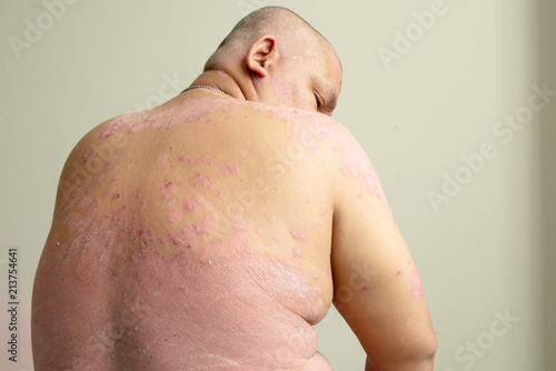 A sick man with psoriasis photo