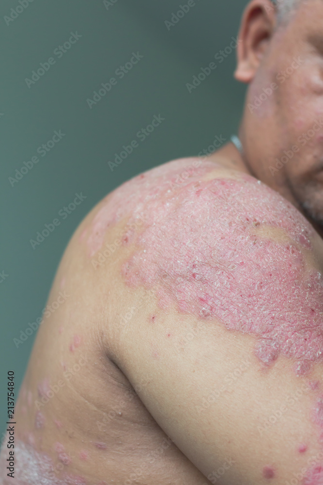 Fototapeta premium Patients look at their own shoulder filled with inflammation
