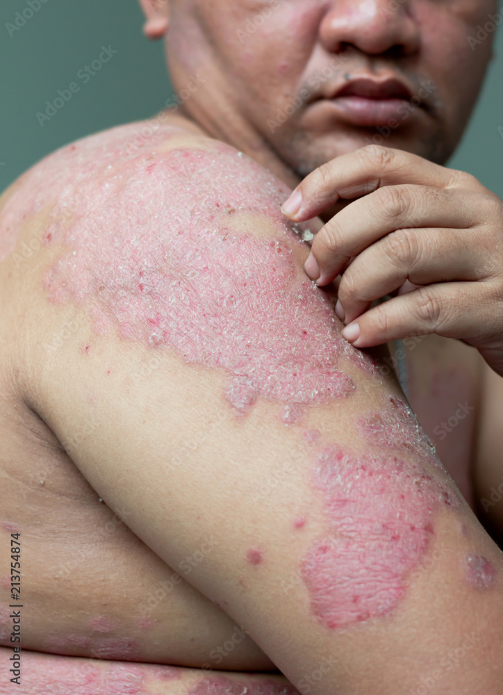 People with psoriasis look at their arms full of wounds and scratche People with psoriasis look at their arms full of wounds and scratche