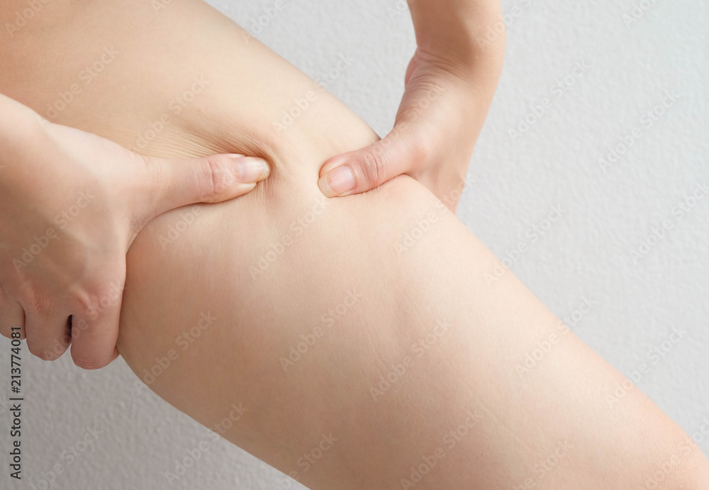 Female legs thighs with cellulite. Skin problem, body care, overweight and dieting concept, diabetic risk factor. Female legs thighs with cellulite. Skin problem, body care, overweight and dieting concept, diabetic risk factor.