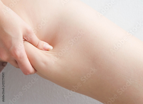 Female legs thighs with cellulite. Skin problem, body care, overweight and dieting concept, diabetic risk factor.