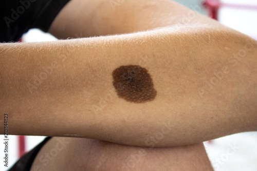large mole on the skin