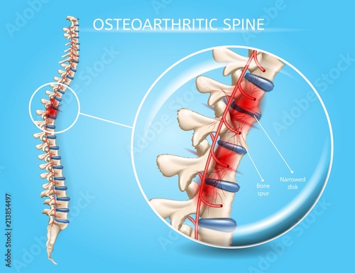 Spinal Osteoarthritis Realistic Vector Concept