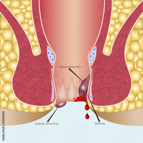 Internal hemorrhoids and external hemorrhoids